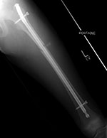 IM femoral nail